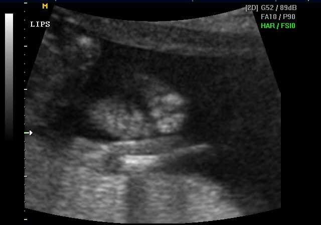 Ultrasound — Kennedy's lips