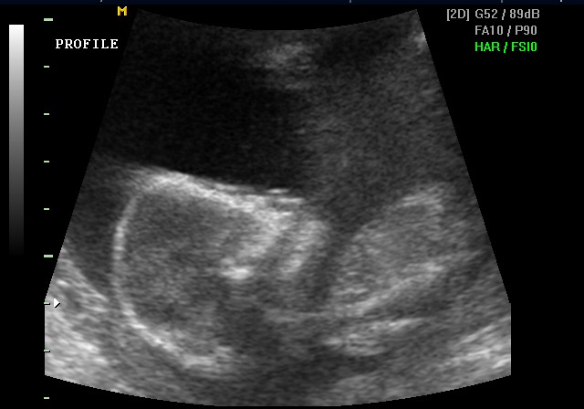 Ultrasound — Kennedy's profile, May 23, 2005